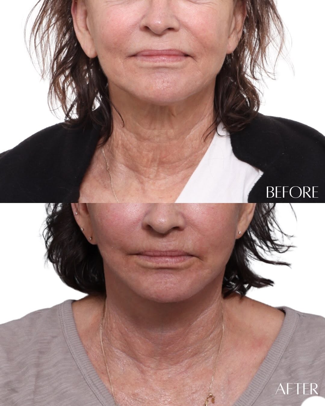 Instagram post by Dr. David Gilpin: The Power of the Deep Neck Lift✨ This patient is 4 months post-op Deep Neck Lift with Extended Deep Plane Facelift - The neck is often one o…