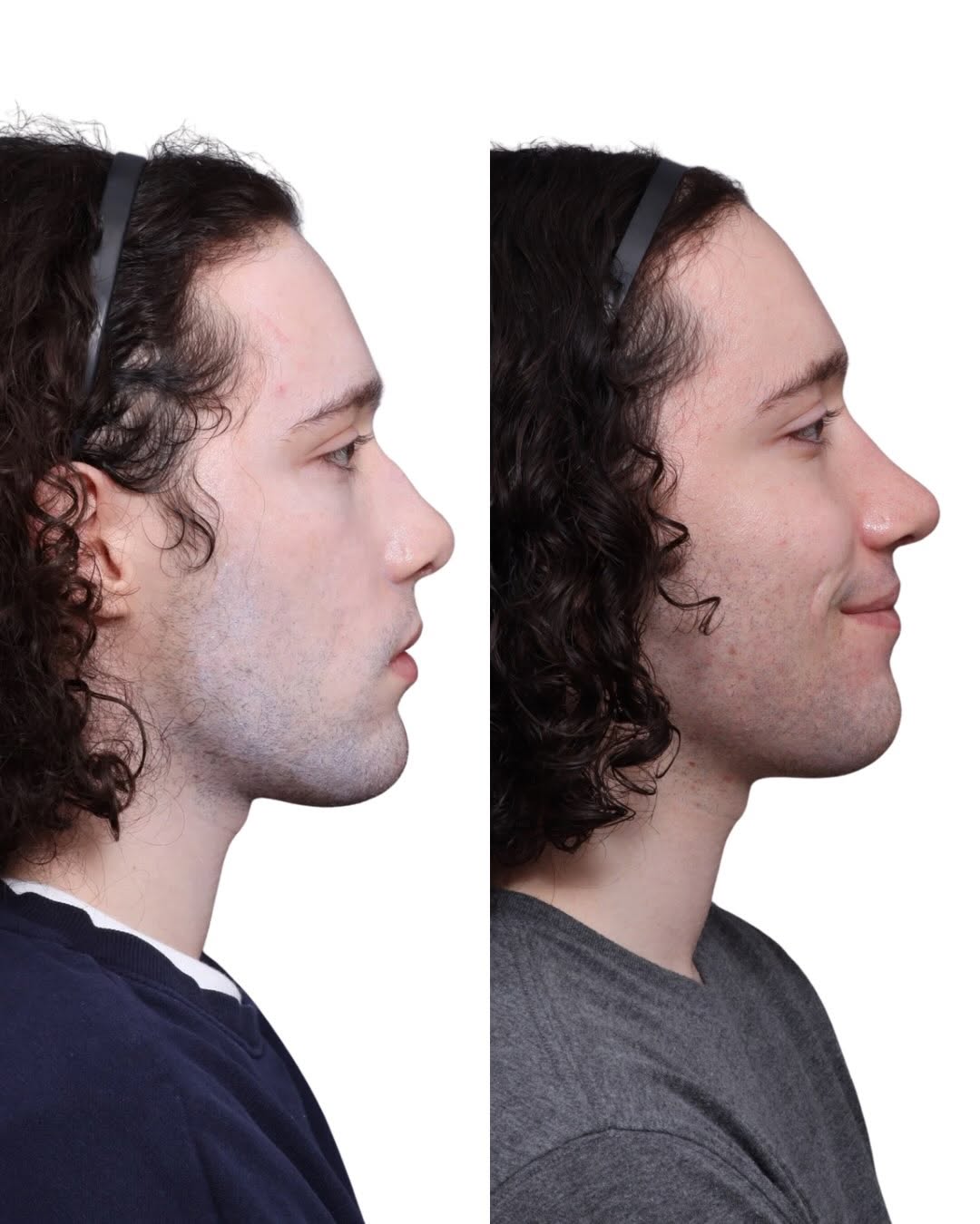Instagram post by Dr. David Gilpin: A stronger profile starts with balance. 👃 This patient is 3 months post-op Rhinoplasty and is already seeing balanced results as swelling w…