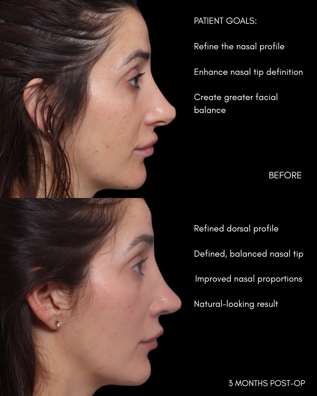 Instagram post by Dr. David Gilpin: 3 Months Post-Op Rhinoplasty ✨ Refined dorsal profile, enhanced tip definition, and improved facial balance while maintaining a natural resu…