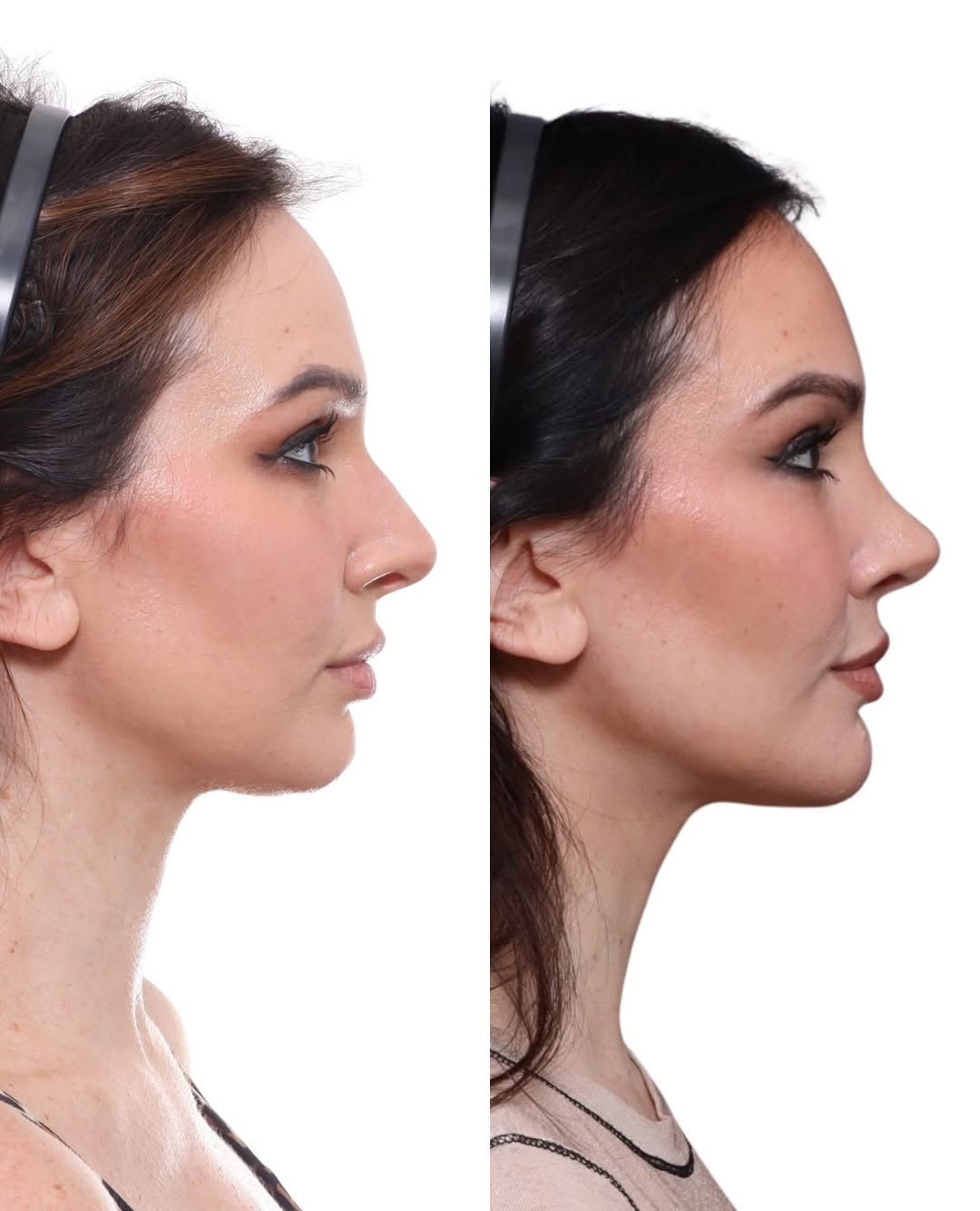 Instagram post by Dr. David Gilpin: ✨ 10 months post-op rhinoplasty ✨ A refined profile and balanced nasal appearance while maintaining her natural features. At 10 months, her …