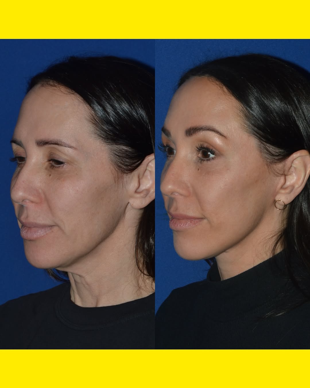 Instagram post by Dr. David H. Harley: Four months after #facelift #necklift #browlift and #upperblepharoplasty. Swipe for more views.