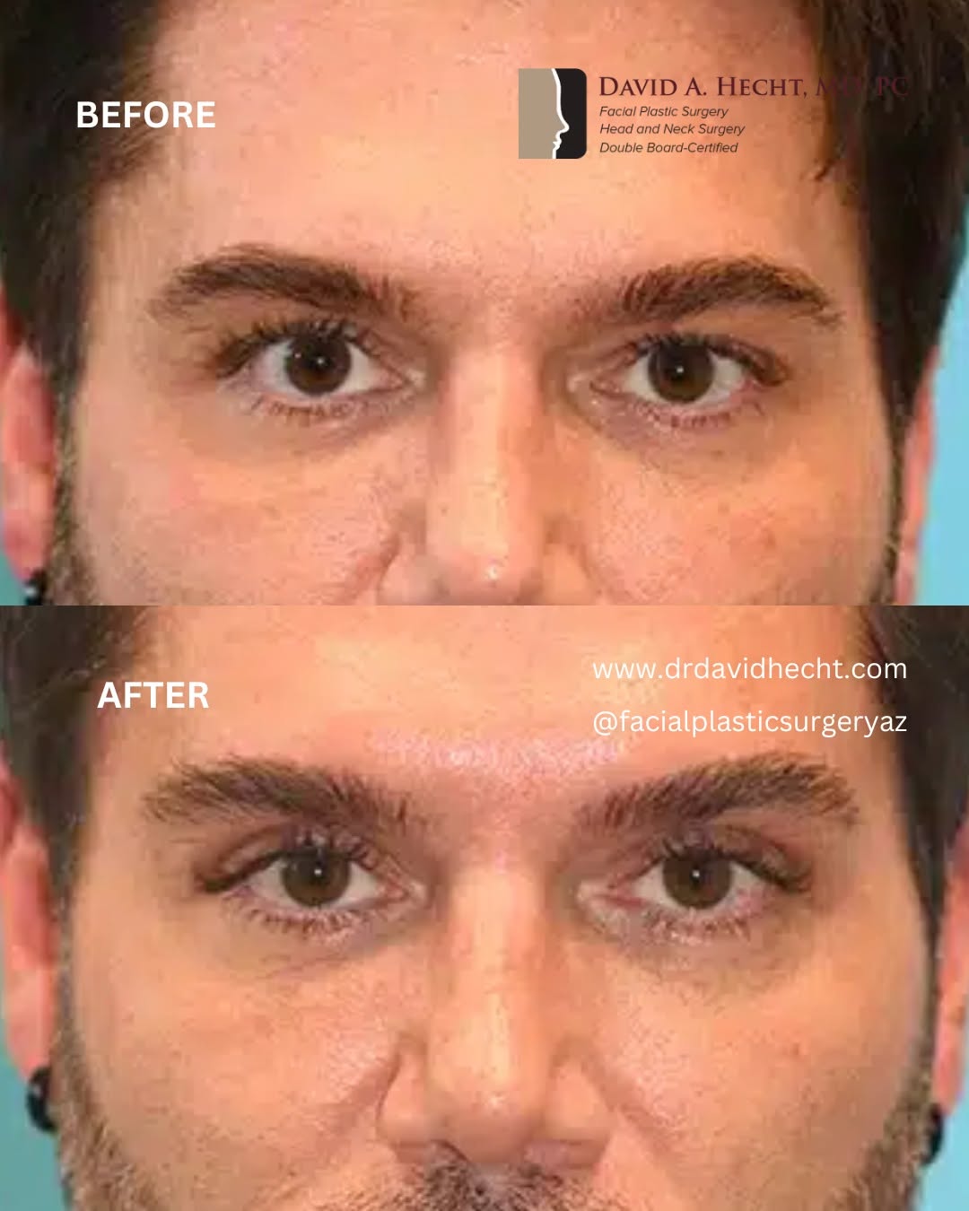 Instagram post by Dr. David Hecht: Upper blepharoplasty (eyelid lift) results in a younger male patient who presented with hooded eyes and wanted a refresh with David A. Hecht…