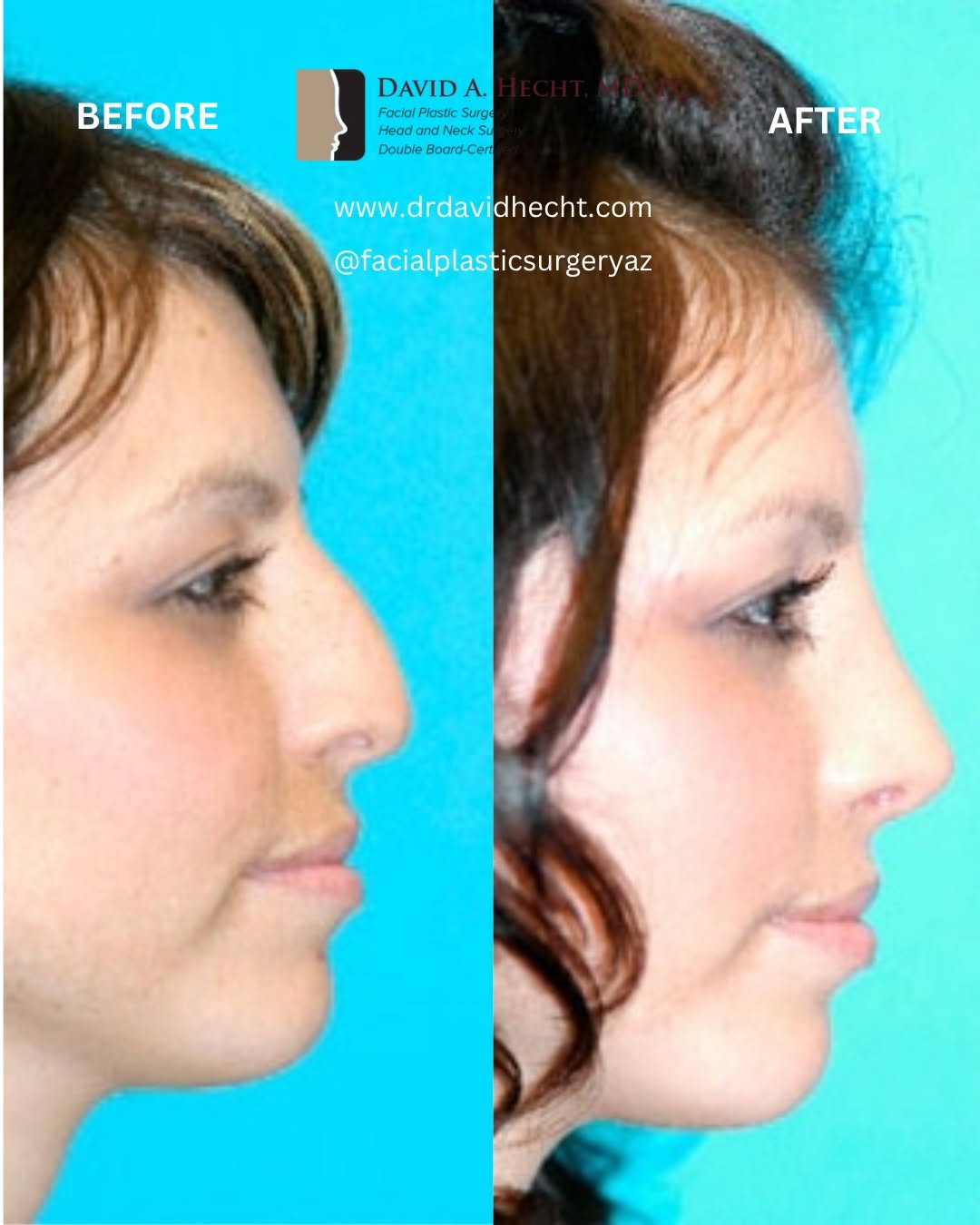 Instagram post by Dr. David Hecht: Rhinoplasty Transformation: Notice the change from a prominent dorsal hump and downturned nasal tip in the "before" image to a smooth bridge…