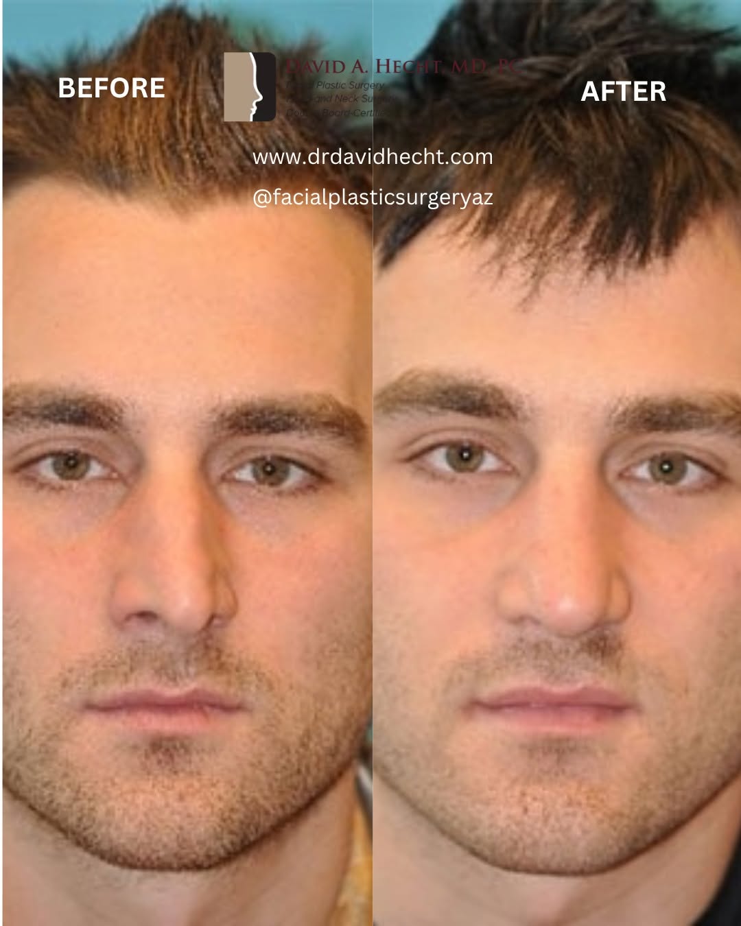 Instagram post by Dr. David Hecht: Another amazing rhinoplasty transformation! Note the correction of the dorsal hump and nasal tip, achieving a smooth, balanced profile, as w…