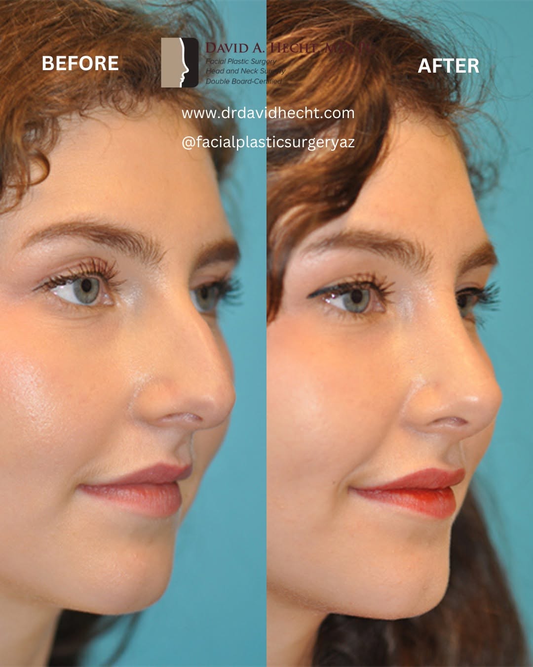 Instagram post by Dr. David Hecht: Rhinoplasty Results 🤩 This beautiful young patient came to us, unhappy with her hooked, aquiline nose. Hooked noses with prominent dorsal h…