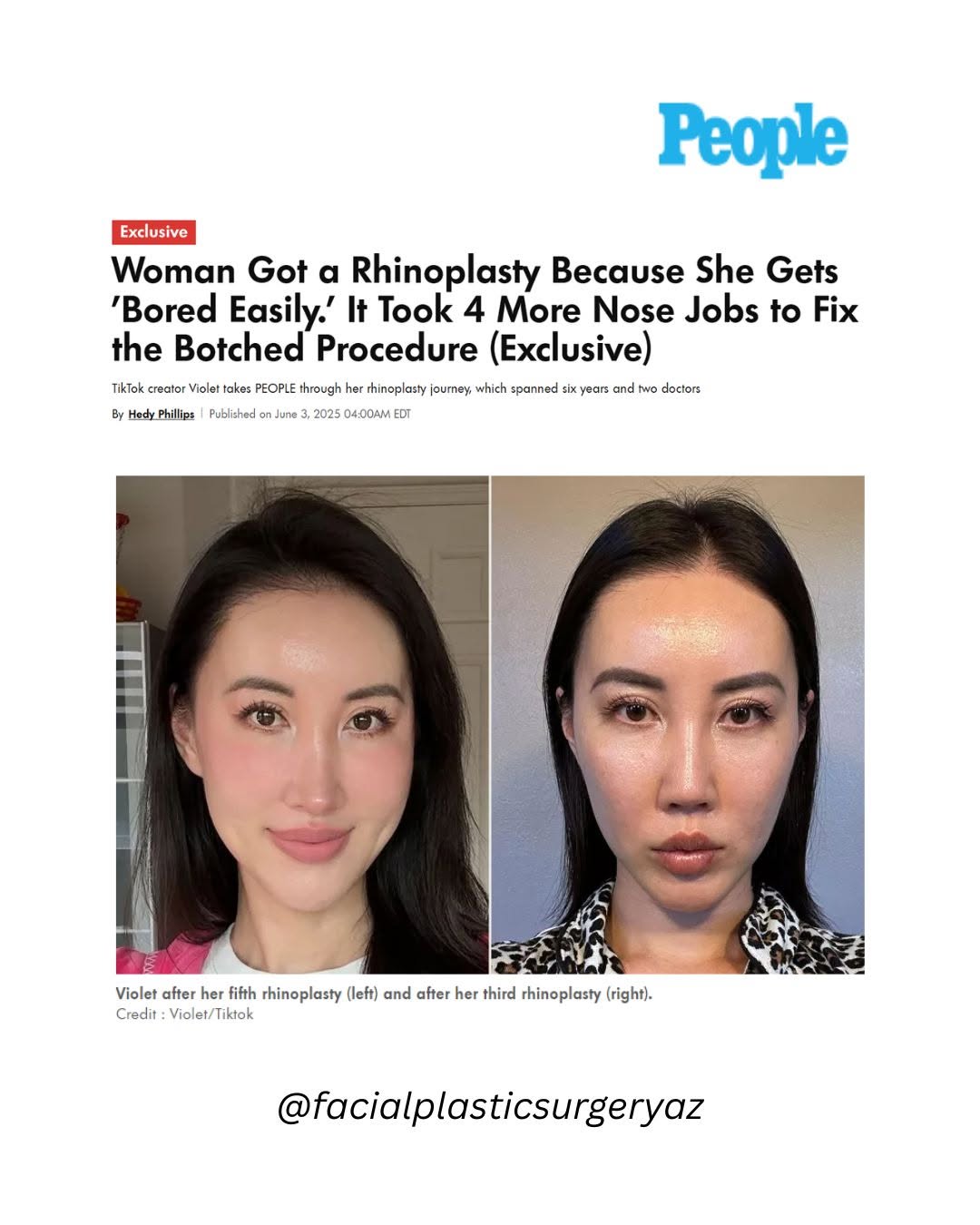 Instagram post by Dr. David Hecht: Sometimes the journey to feeling confident takes more than one try. This story reminds us that one poorly executed rhinoplasty can lead to a…