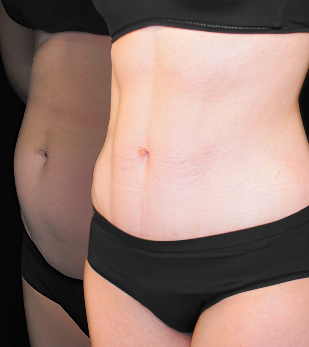 Instagram post by Dr. David Hill: Not every postpartum belly needs a full tummy tuck. The key question is where the laxity is. This patient, one year postpartum, had minimal …