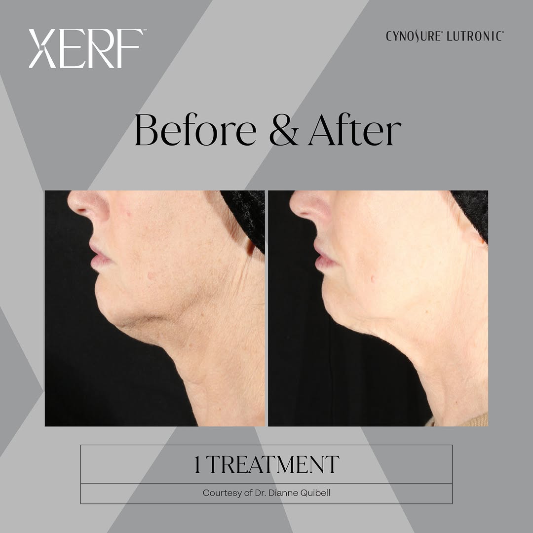 Instagram post by Dr. David J. Applebaum: ✨ Before & After: Just 1 XERF™ Treatment ✨ These results show a visible improvement in skin laxity and jawline definition. XERF uses advance…
