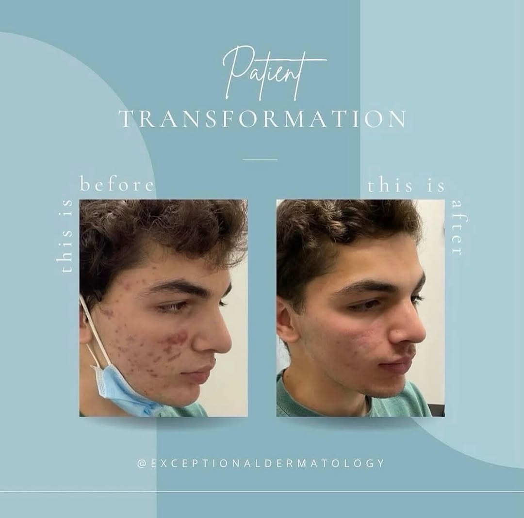 Instagram post by Dr. David J. Sire: Before & After: Acne treatment with Accutane To Book an Appointment with one of our providers: DM: @exceptionaldermatology ☎️ (714) 882-5525…