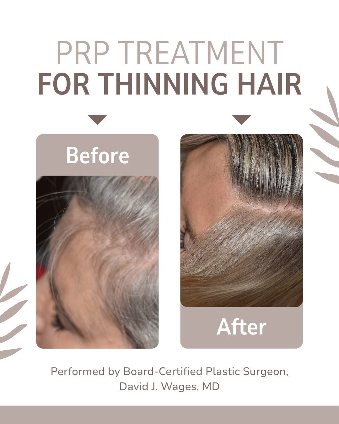 Instagram post by Dr. David J. Wages: 🎉Thinning hair can be reversed!🎉 For men and women with thinning hair, platelet-rich plasma (PRP) treatments can be used to stimulate hair…