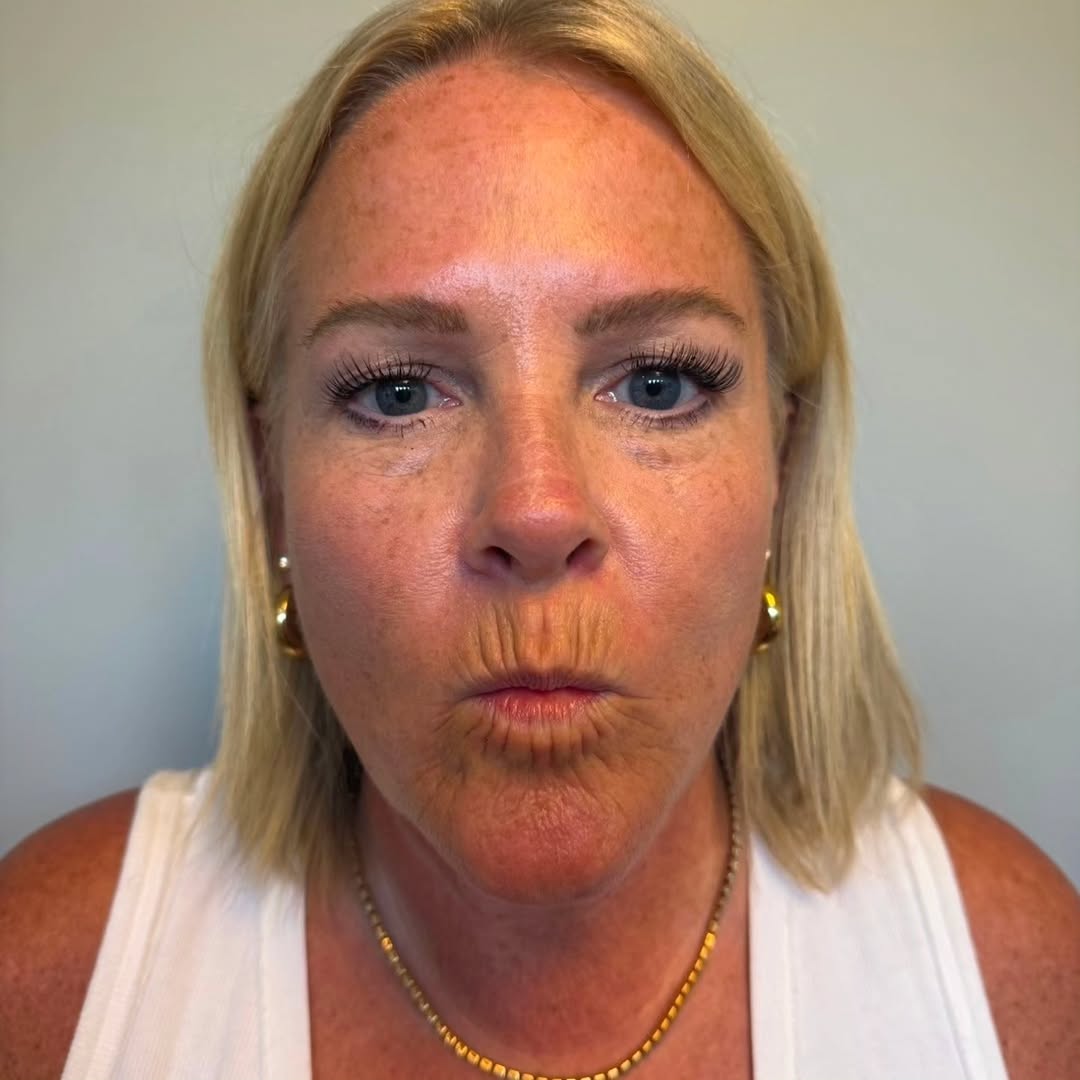Instagram post by Dr. David J. Wages: Lip lines can be hereditary. We have highly-trained Nurse Injectors and quality products to treat the area and give you a softened, refreshe…