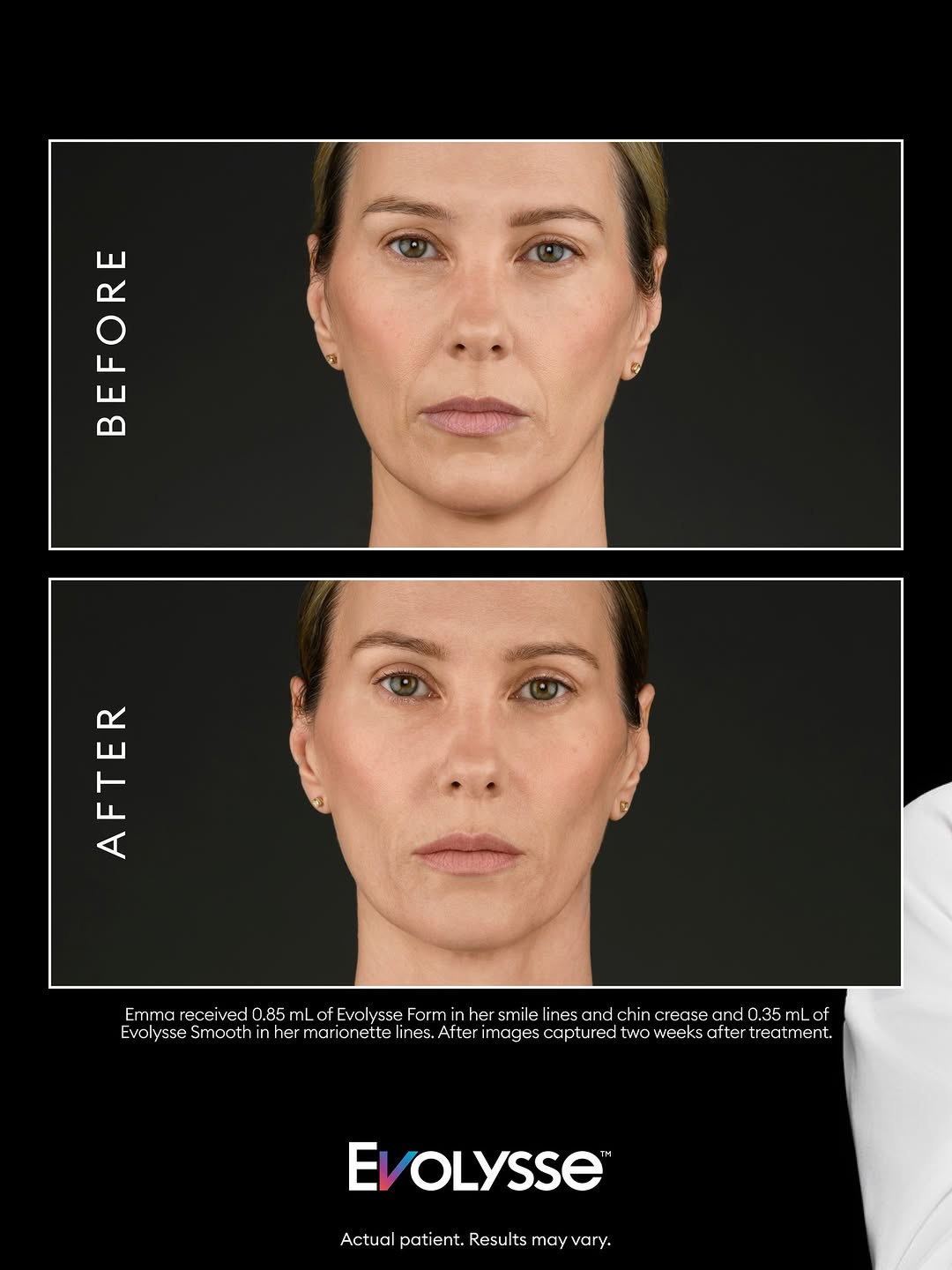 Instagram post by Dr. David J. Wages: 🎉$100 OFF Evolysse Filler🎉 Our Nurse Injectors are THE BEST! Known for their precision, advanced injecting techniques and giving patients …
