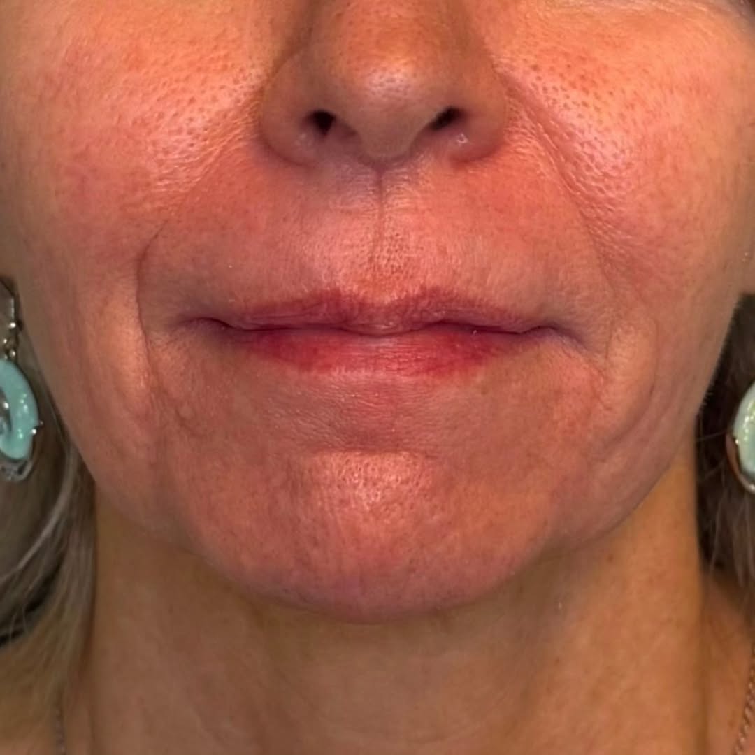 Instagram post by Dr. David J. Wages: Subtle, natural-looking smoothing with fillers. Our Nurse Injectors are THE BEST! Known for their precision, advanced injecting techniques a…