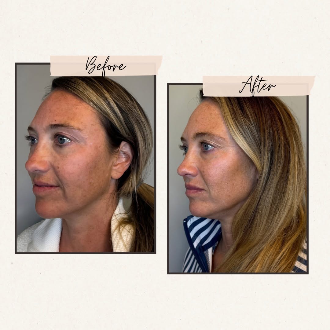 Instagram post by Dr. David J. Wages: 😍What a glow-up with 'tox and filler! Our Nurse Injectors are THE BEST! Known for their precision, advanced injecting techniques and giving…