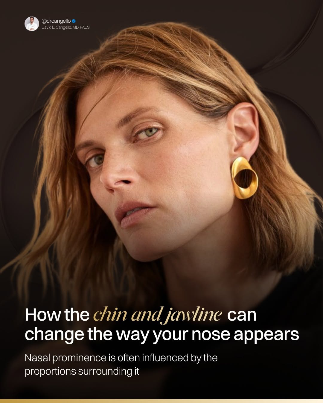 Instagram post by Dr. David L. Cangello: The nose does not exist in isolation. A small or recessed chin can make the nose appear more projected, while a stronger chin and jawline ca…