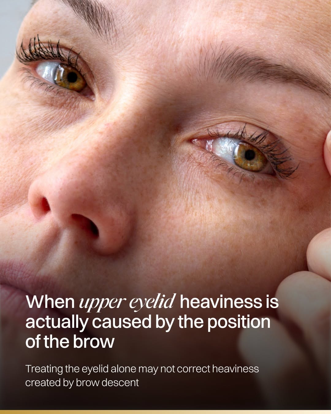 Instagram post by Dr. David L. Cangello: Upper eyelid heaviness is not always caused by excess eyelid skin. As the brow descends, it can push tissue downward and create crowding abo…