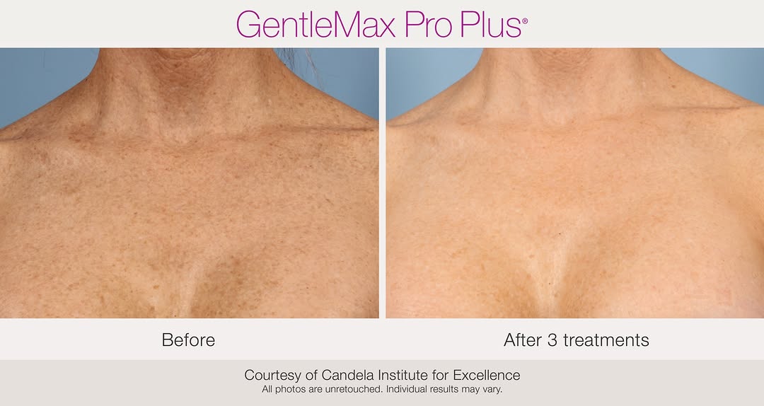 Instagram post by Dr. David M. Pariser: Freckles, sun spots, age spots, dark marks, post inflammatory hyperpigmentation spots are all different forms of pigment that are treatable …