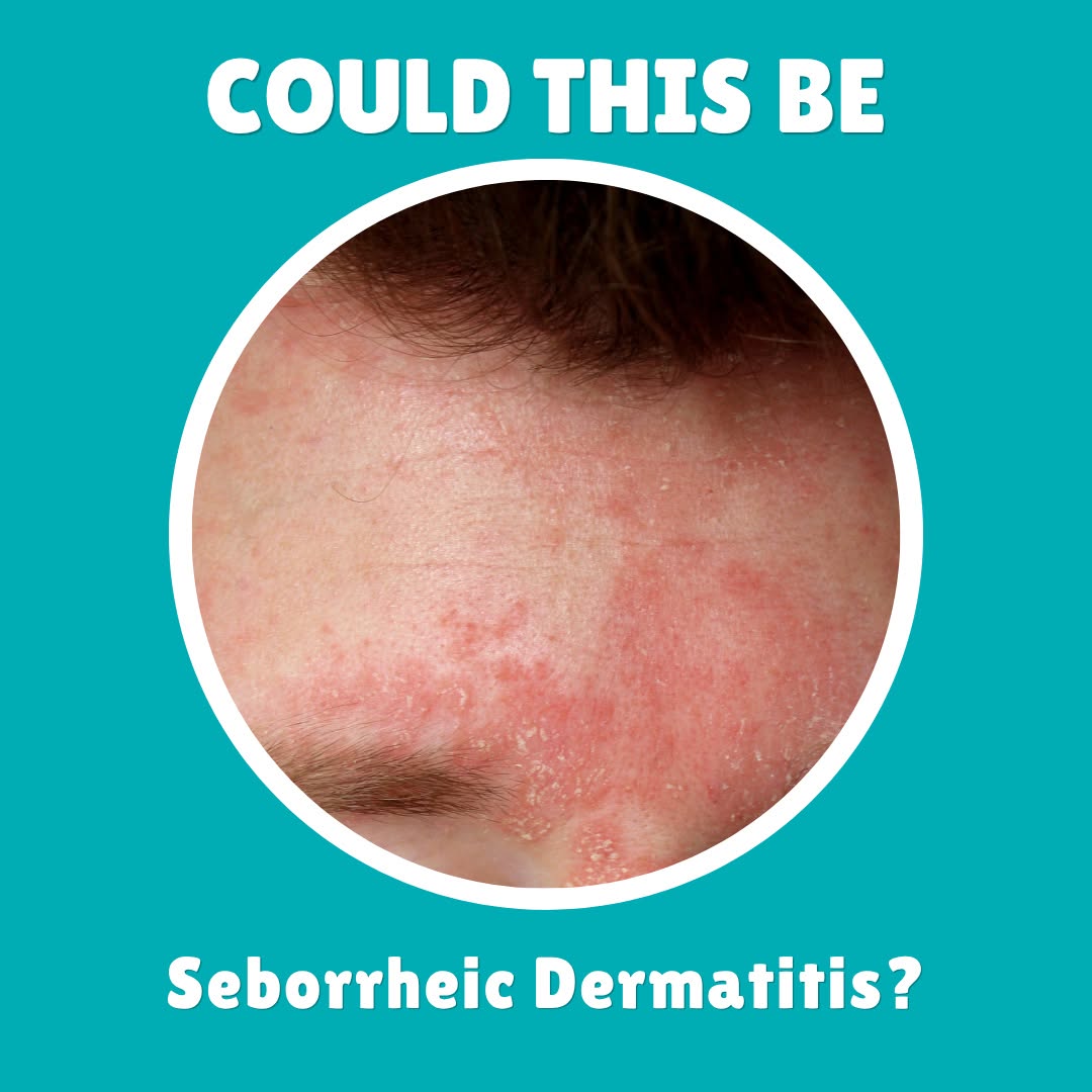 Instagram post by Dr. David M. Pariser: Seborrheic dermatitis can appear differently depending on your skin tone and the area affected. Common signs include: 👉️White or yellow,…