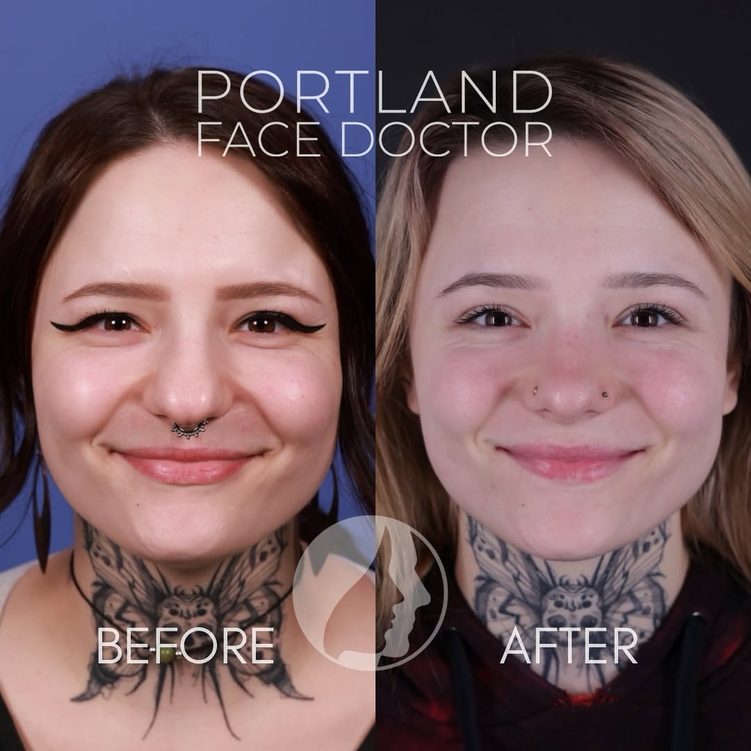 Instagram post by Dr. David Magilke: Restoring harmony in the face is one of the most powerful things that can be done with a rhinoplasty. This patient was bothered by the tip o…