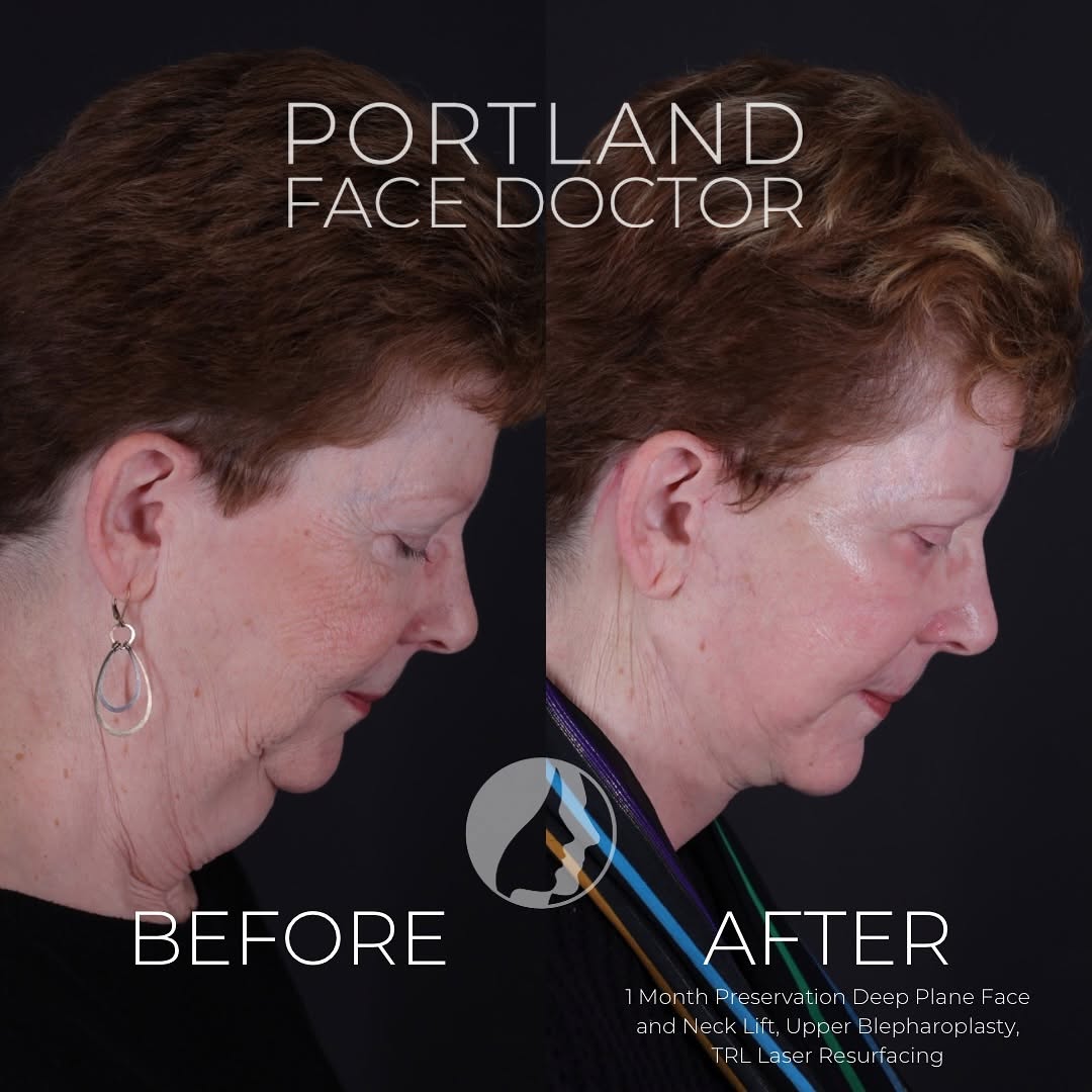 Instagram post by Dr. David Magilke: Sandy’s got a new lease on life! This wonderful 66-year-old patient is pictured 1 month out from her facelift surgery that included: 1️⃣ Pre…