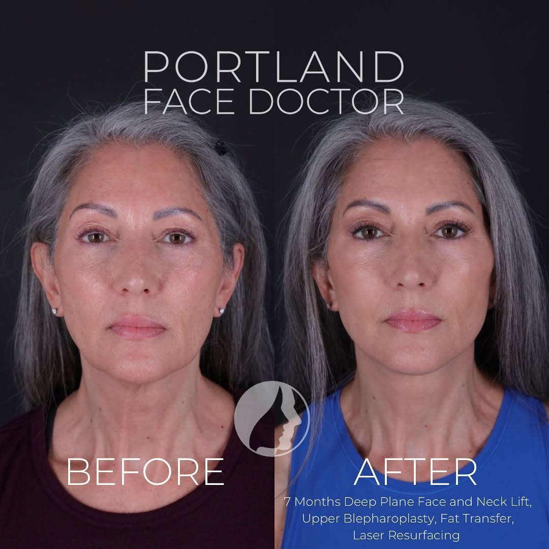 Instagram post by Dr. David Magilke: This gorgeous 62-year-old woman decided it was time for a facial refresh. She takes great care of herself, and has a beautiful canvas to wor…