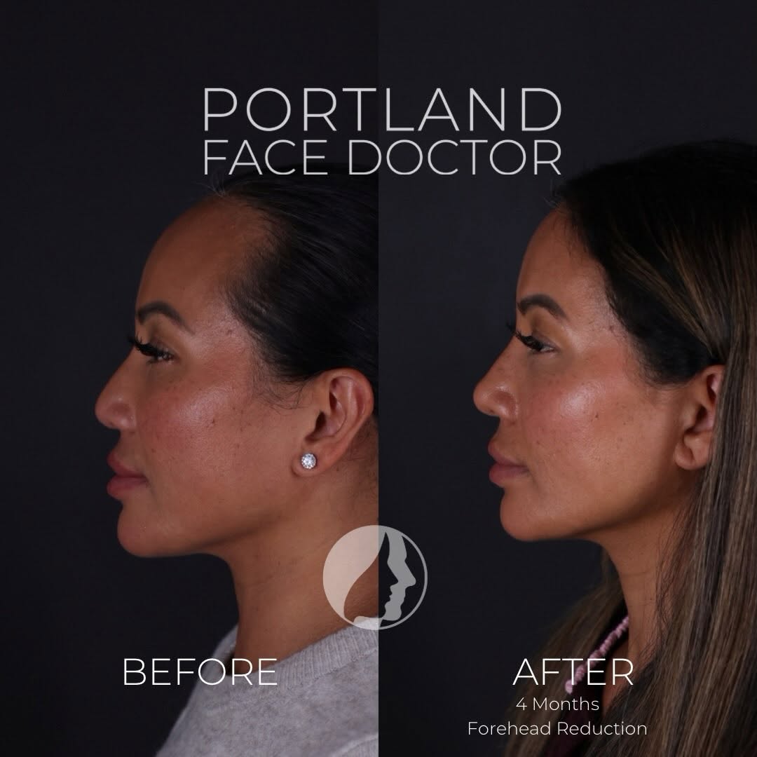 Instagram post by Dr. David Magilke: A forehead reduction is a procedure most people don’t know about that can dramatically improve facial harmony. For women born with a high ha…