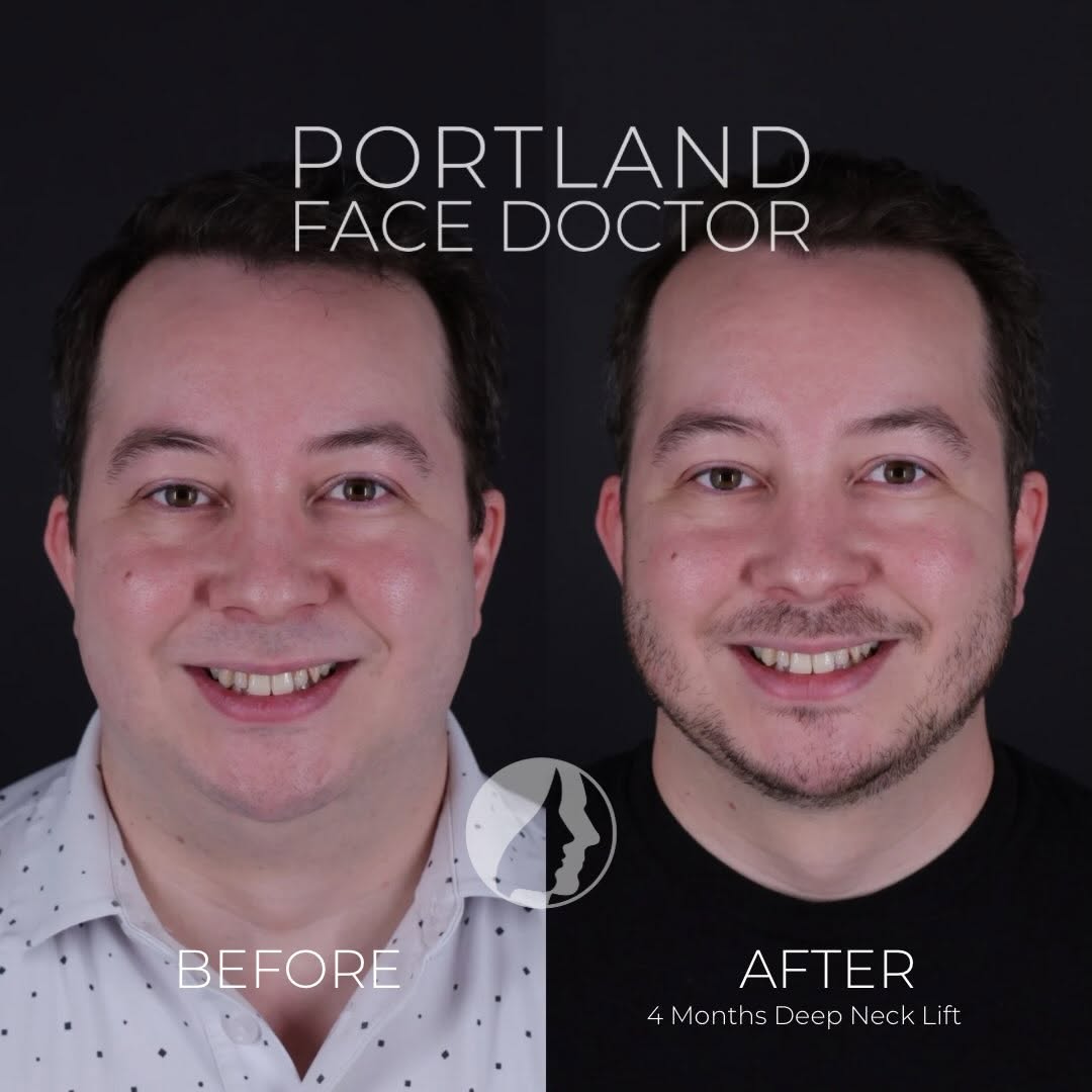 Instagram post by Dr. David Magilke: Improving self-confidence with a dramatic transformation is what gets me going. A deep neck lift is one of the most powerful facial rejuvena…