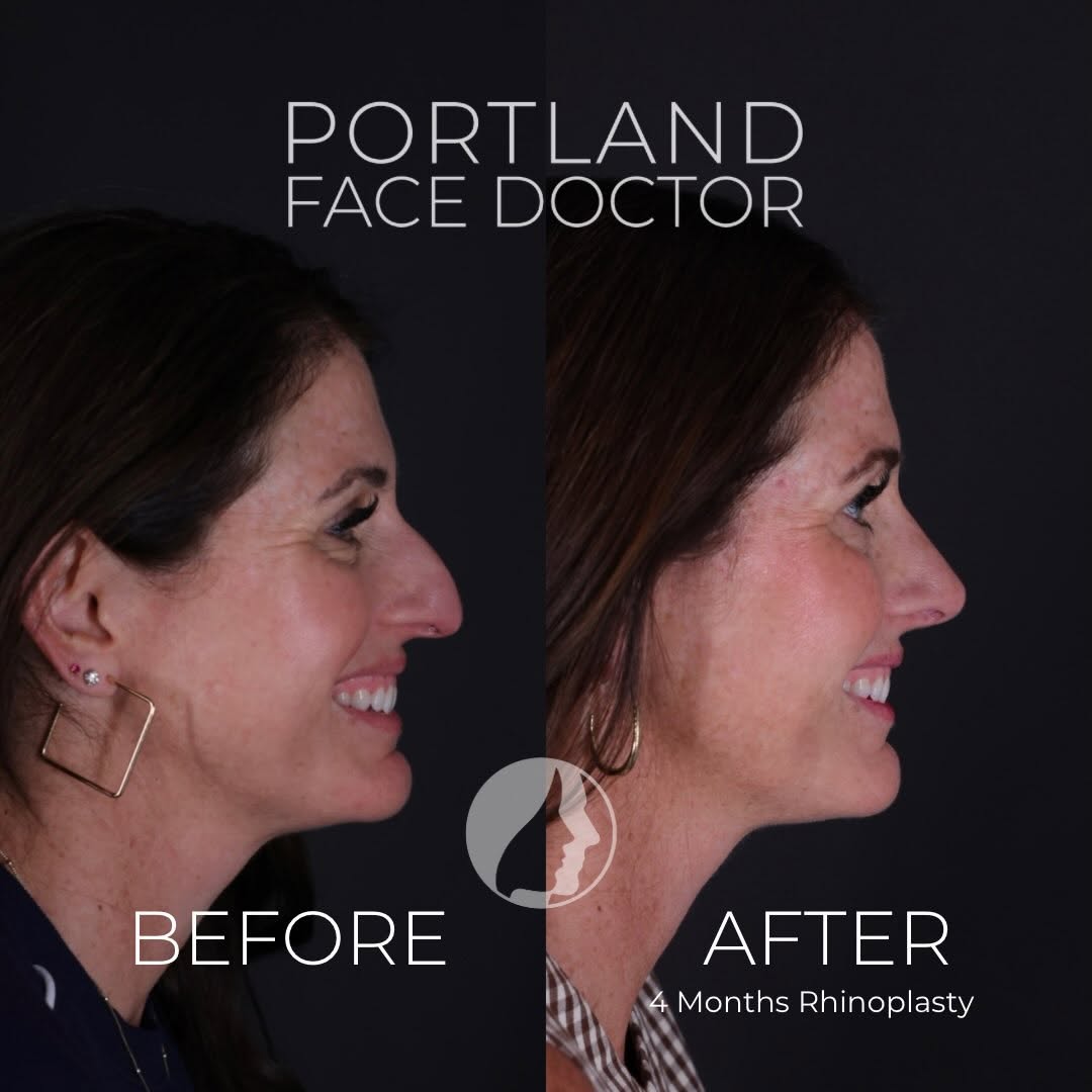Instagram post by Dr. David Magilke: A beautiful nose for a beautiful face. This lovely patient wanted to reduce the dorsal hump, while lifting her tip for a more feminine appea…