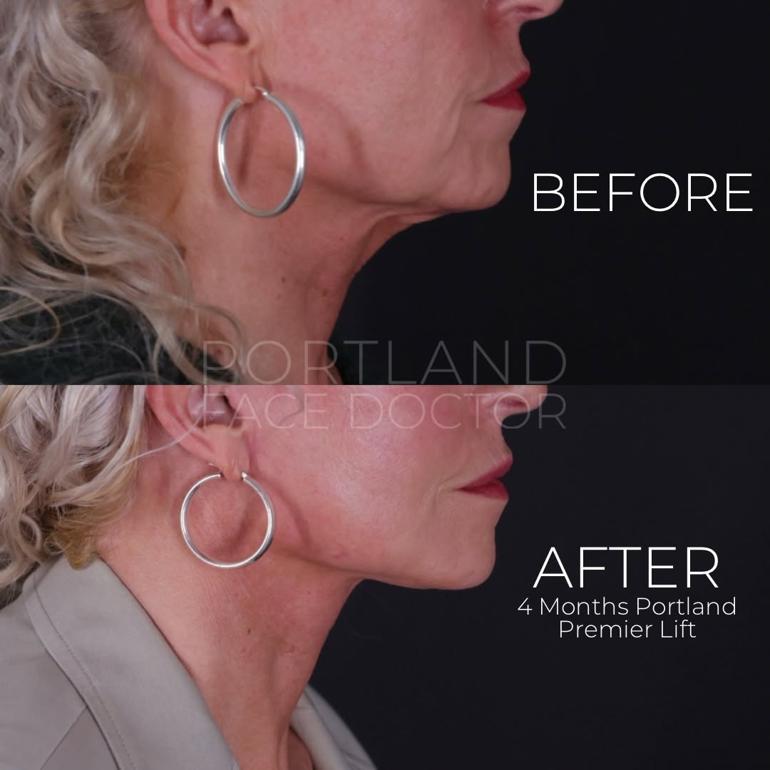 Instagram post by Dr. David Magilke: 57 years young, and a jawline better than ever. This patient was concerned about some signs of aging on her lower face after losing about 40…