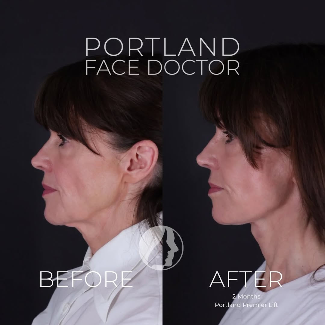 Instagram post by Dr. David Magilke: 66 years of age, with her jawline and neck beautifully restored in harmony with the rest of her face. This lovely patient was noticing some …