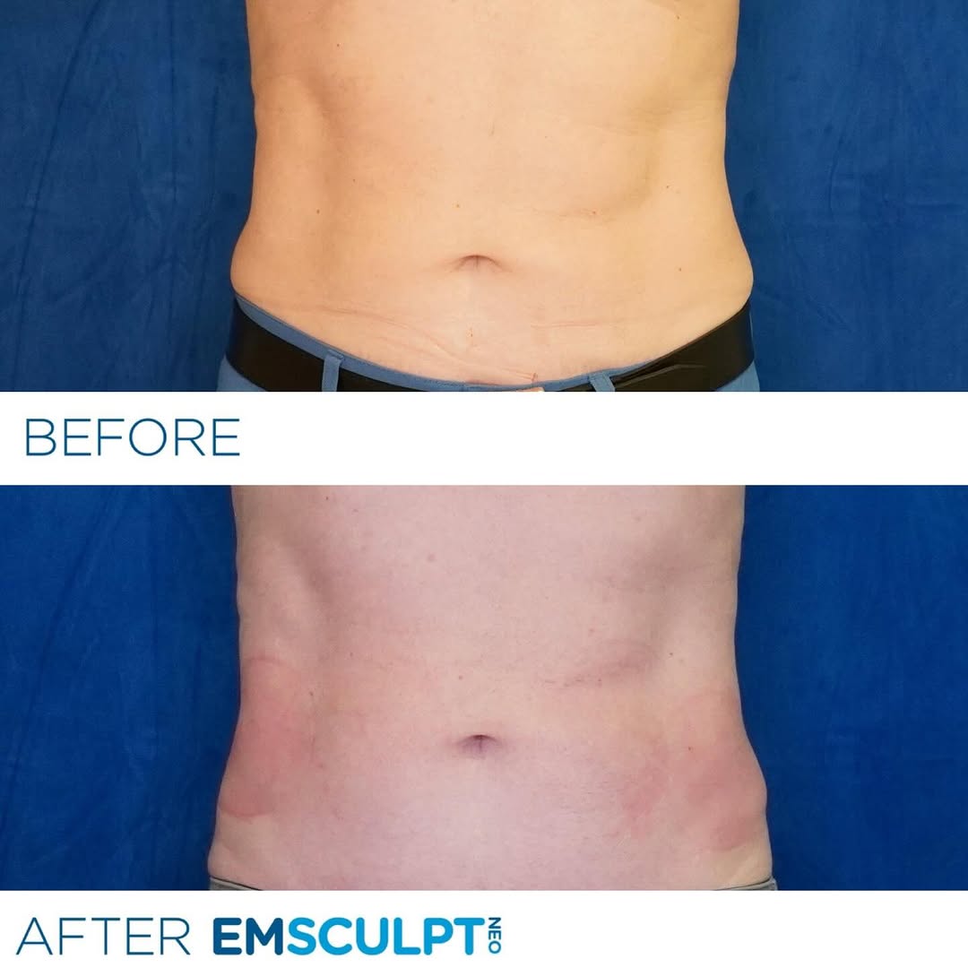 Instagram post by Dr. David No: Real patient results in just 4 sessions! Get ready to transform with EmSculptNEO. Call for your complimentary consultation 916-983-3373 #ems…