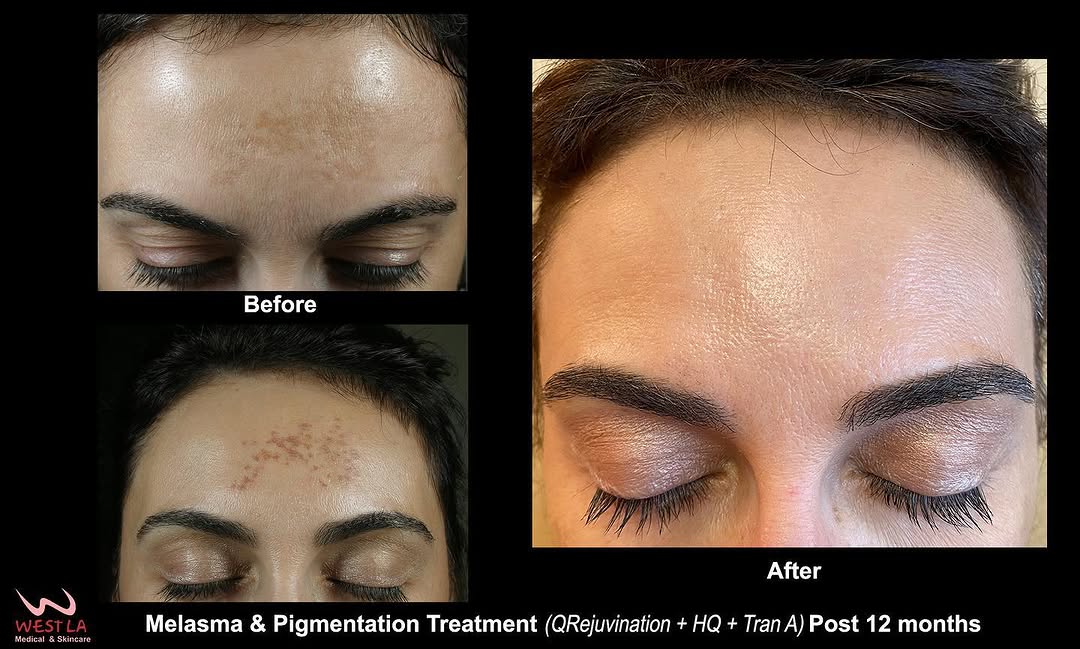 Instagram post by Dr. David P. Melamed: It’s been a journey dealing with Melasma. Thank you Dr. Melamed for giving me my confidence back! #westlaskincare #drdavidmelamed #melasmatr…