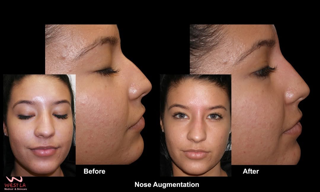 Instagram post by Dr. David P. Melamed: Non-Surgical Rhinoplasty safe and effective alternative to plastic surgery for those who are seeking subtle, natural looking nose reshaping