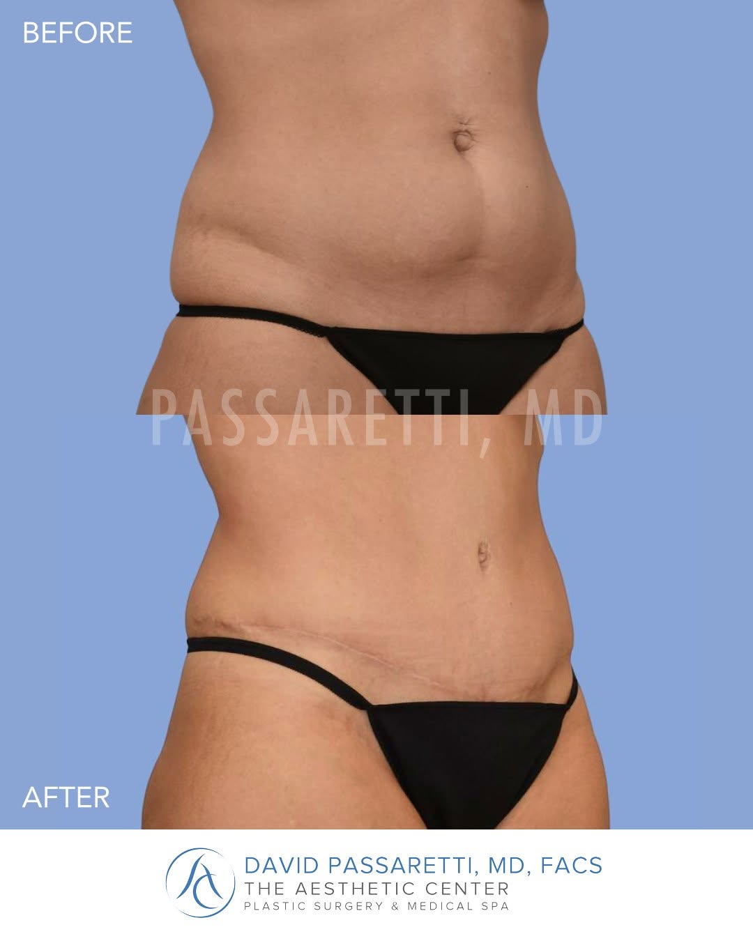 Instagram post by Dr. David Passaretti: A flatter, tighter foundation. This abdominoplasty removes excess skin and contours the abdominal wall, creating a smoother, firmer abdomen …