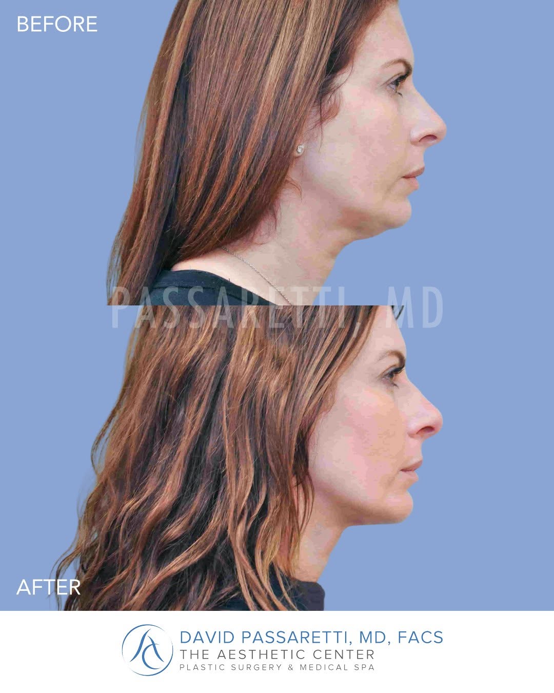 Instagram post by Dr. David Passaretti: Balance, redefined. A chin implant creates the facial harmony many patients are looking for, bringing the chin into proportion with the rest…