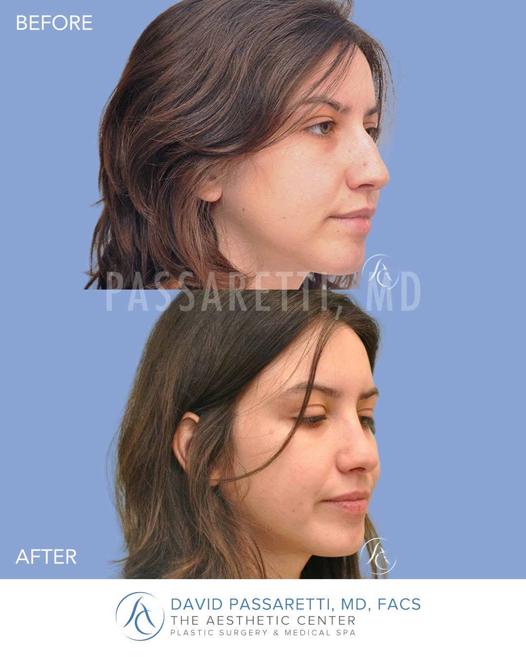 Instagram post by Dr. David Passaretti: Subtle changes, striking results. This patient's rhinoplasty results showcase a softer, more balanced profile, achieved through Dr. Passaret…