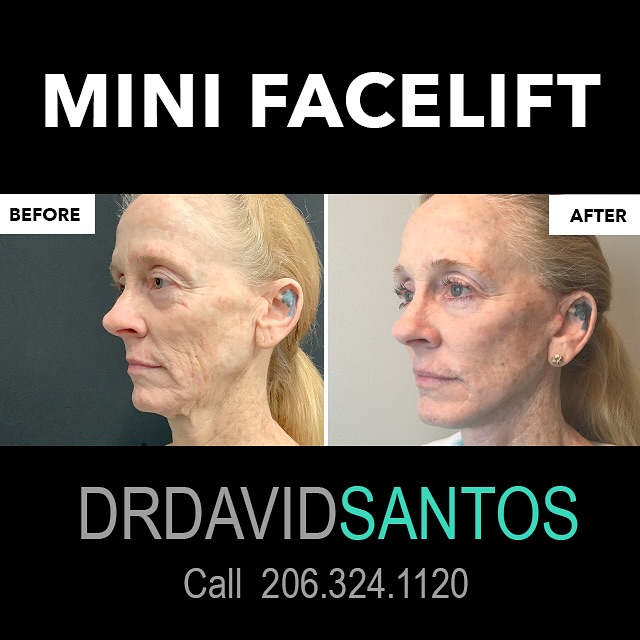 Instagram post by Dr. David Q. Santos: Look like yourself, but younger! 😇 This patient came to Dr. Santos wanting to address sagging skin on her lower face. The patient has seen …