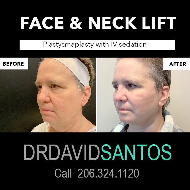 Instagram post by Dr. David Q. Santos: ✨ Face & Neck Lift Transformation ✨ Our patient experienced a remarkable rejuvenation with a face and neck lift, including a platysmaplasty …