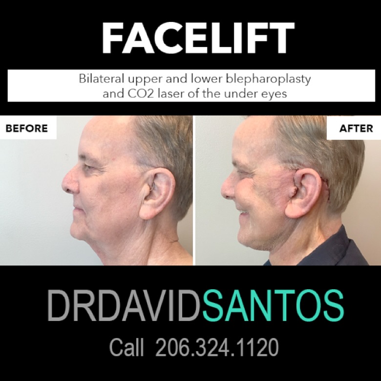 Instagram post by Dr. David Q. Santos: Rewind the years with precision and care! This patient achieved a remarkable transformation with a facelift, including bilateral upper and l…