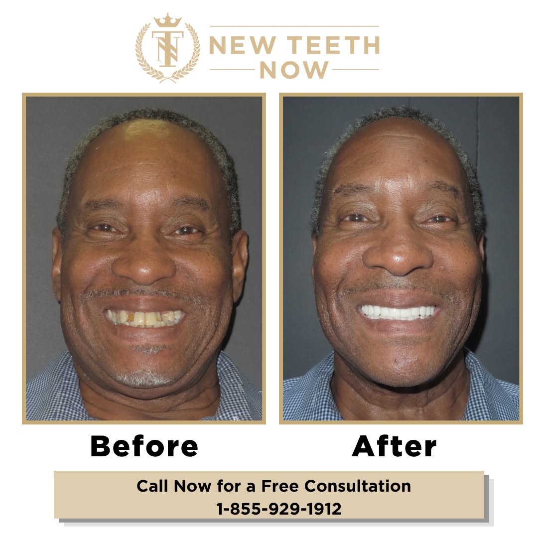 Instagram post by Dr. David R. Kirkpatrick, D: A new smile should look like you! Calvin came to New Teeth Now with uneven, crooked and stained teeth, and spacing that affected his smile. …