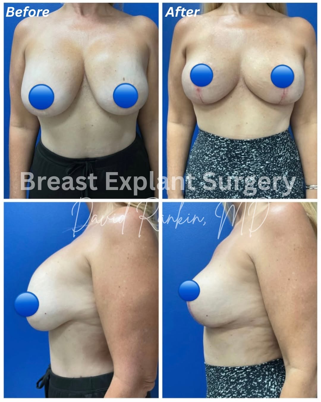 Instagram post by Dr. David Rankin: Only ONE month post-op—and already such a wonderful transformation. This 54-year-old patient underwent breast explant surgery with removal o…