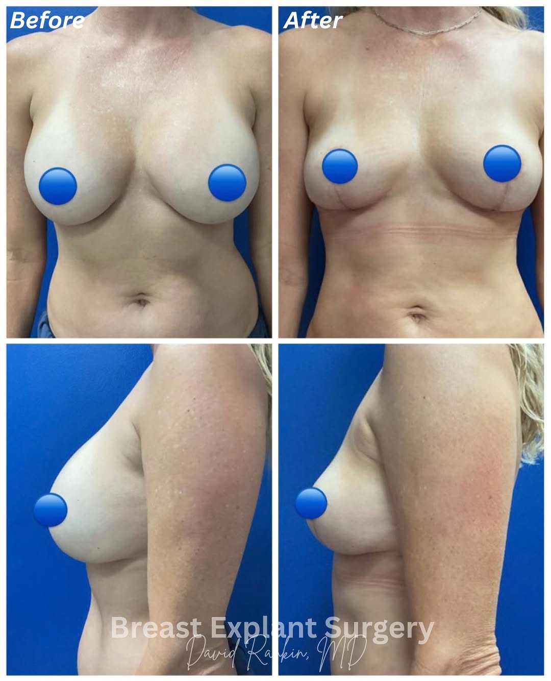 Instagram post by Dr. David Rankin: Only 1 month post-op 45-year-old patient following breast explant with removal of 421cc silicone implants, total capsulectomy, Wise (anchor)…