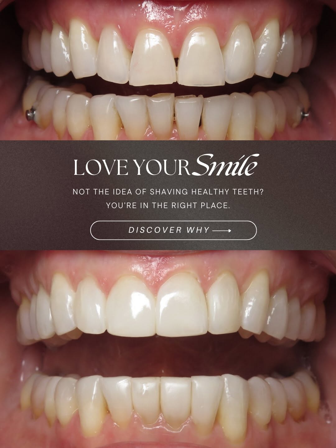 Instagram post by Dr. David S. Eshom: Most people think a smile makeover starts with veneers. We think it starts with preserving your natural teeth. The goal isn’t to do more den…