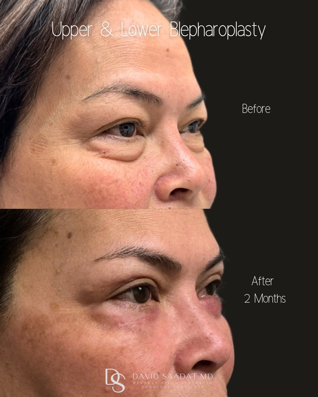 Instagram post by Dr. David Saadat: 👁️Upper & Lower Blepharoplasty This is one of my most lovely patients who underwent upper and lower blepharoplasty. This procedure is desig…