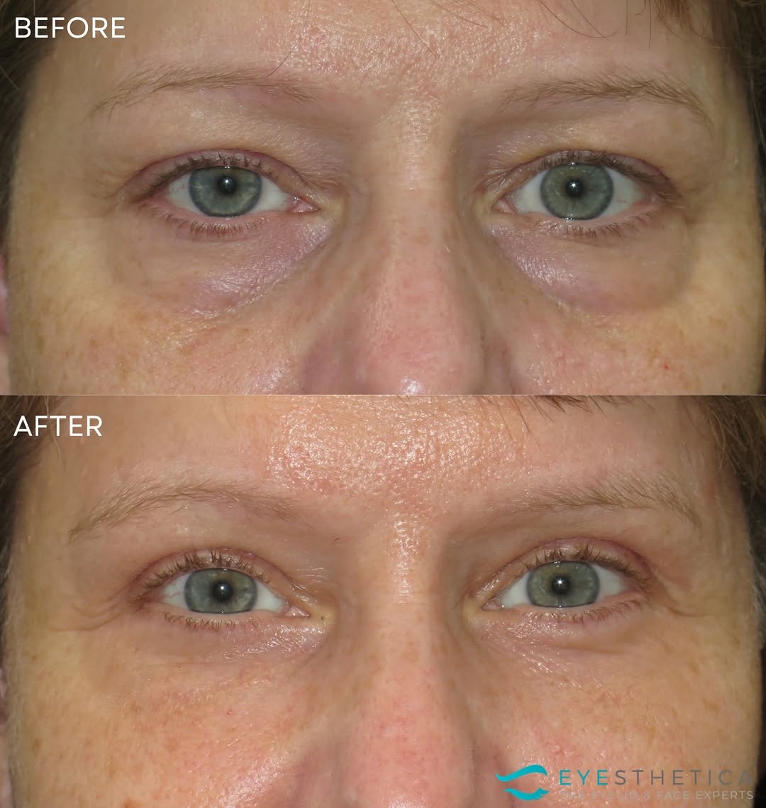 Instagram post by Dr. David Samimi: A comprehensive eye refresh, with each procedure addressing a different component of the aging eye. This patient underwent right ptosis repa…
