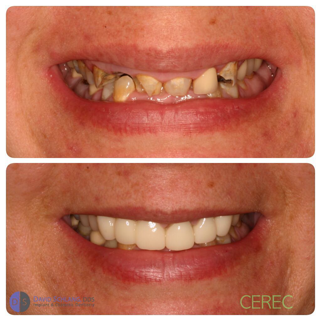Instagram post by Dr. David Schlang: Always nice when you can give someone back their smile and confidence, great patient and a great team. #cerec #veneers