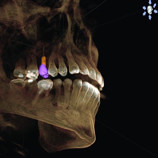 Instagram post by Dr. David Schlang: Amazing New diagnostic tech added to the office with the ORTHOPHOS SL 3D #dental #smiles