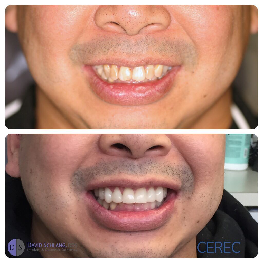Instagram post by Dr. David Schlang: Nice smile and a happy patient thanks to CEREC and my team @drschlangdds #dental #veneers #cerec