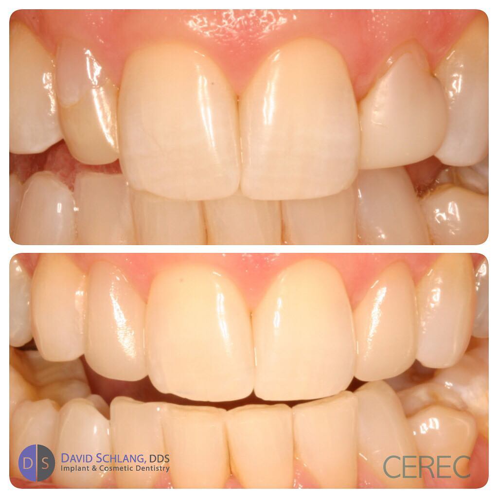 Instagram post by Dr. David Schlang: Same day single visit veneers #CEREC #Veneers