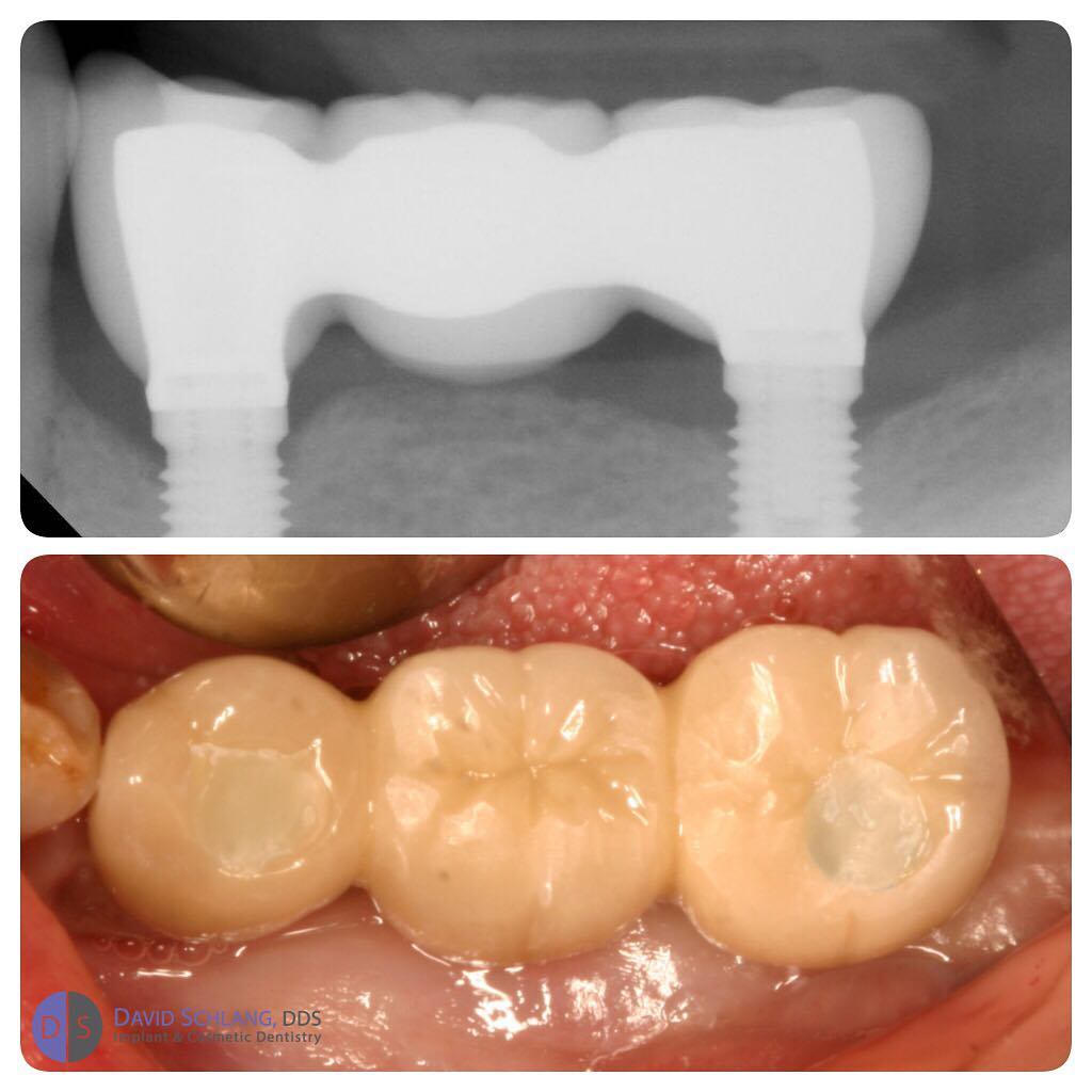 Instagram post by Dr. David Schlang: Amazing when you can give someone back their teeth! #dentalimplant #dentist